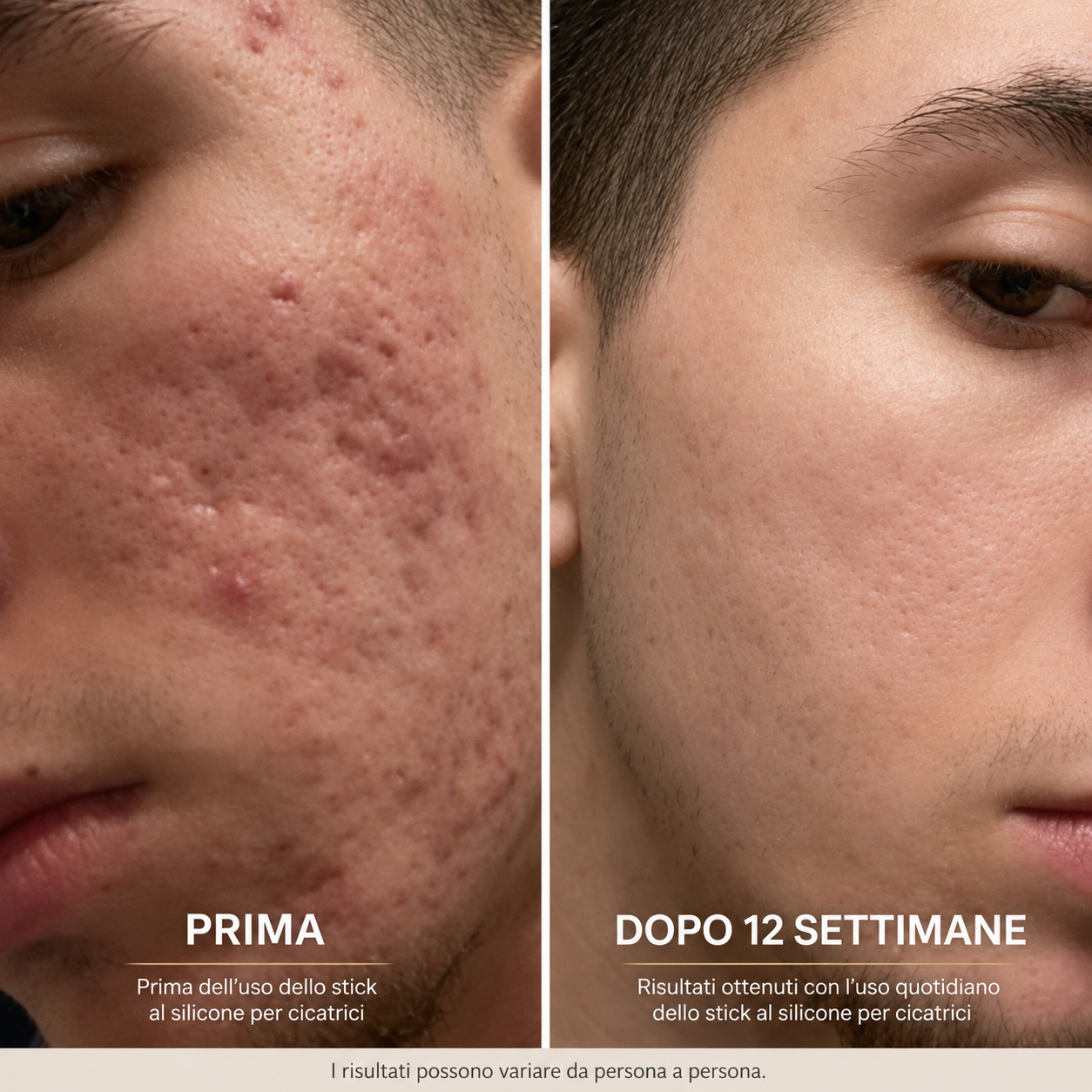 Acne Stick