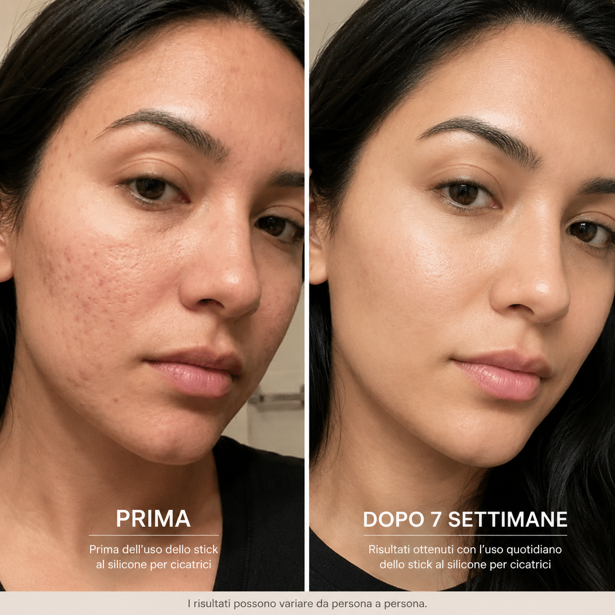 Acne Stick